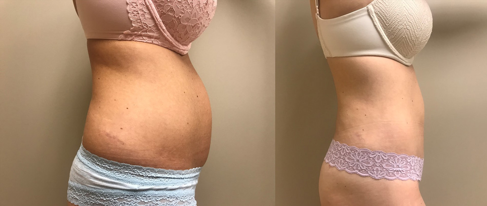 Scottsdale Liposuction Patient 18 | Dr. Shaun Parson