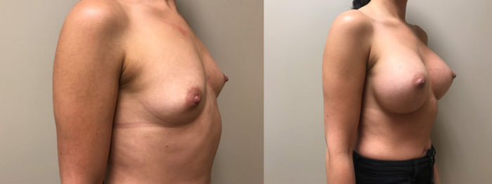 Breast Augmentation Patient 34 | Scottsdale Plastic Surgeon Dr. Shaun Parson