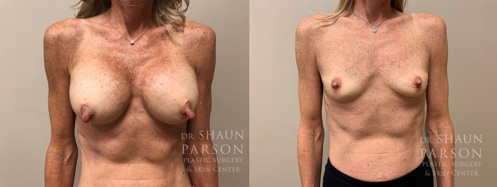 Explant Patient 7 | Scottsdale Plastic Surgeon Dr. Shaun Parson