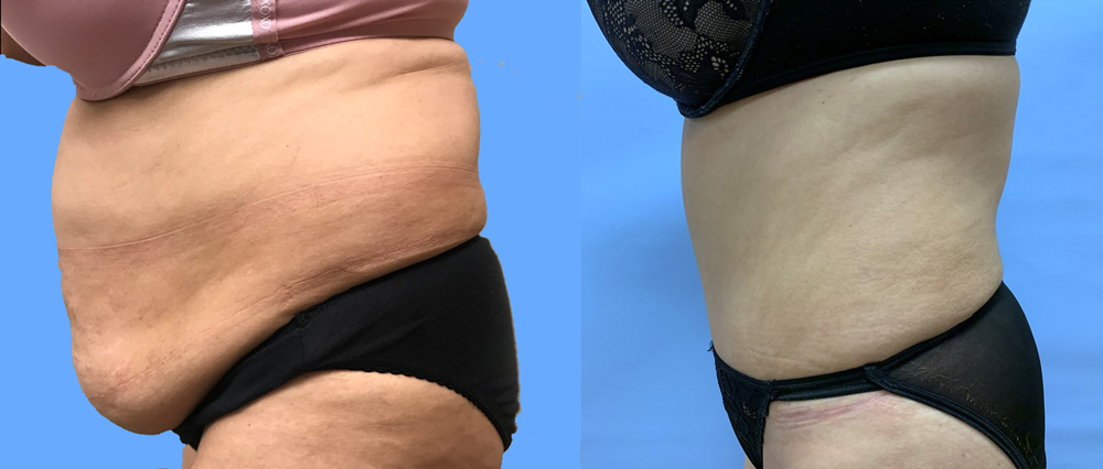 Tummy Tuck Patient 28 | Dr. Shaun Parson Scottsdale, AZ