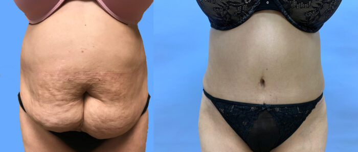 Tummy Tuck Patient 28 | Dr. Shaun Parson Scottsdale, AZ