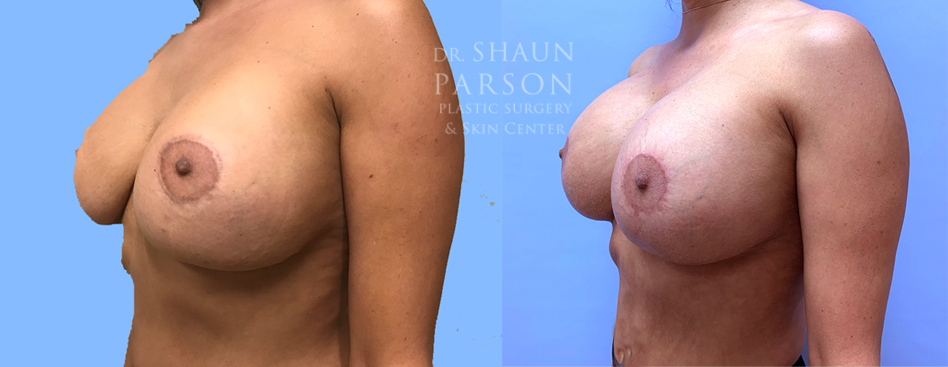 Breast Implant Exchange | Scottsdale Plastic Surgeon