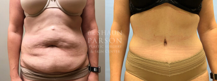 Tummy Tuck Patient 29 | Scottsdale Plastic Surgeon Dr. Parson