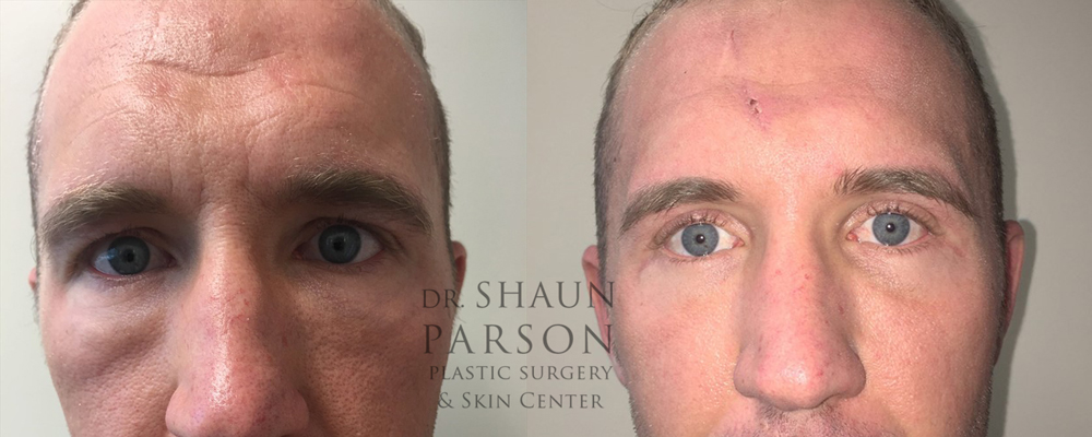 Eyelid Patient 28 | Dr. Shaun Parson, Scottsdale, AZ