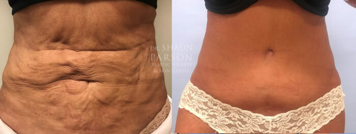 Tummy Tuck Patient 31 | Dr. Shaun Parson, Scottsdale