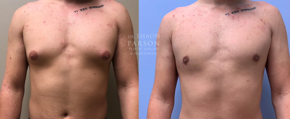 Gynecomastia Patient 17 | Dr. Shaun Parson Plastic Surgery, Scottsdale