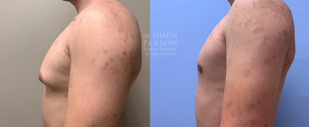 Gynecomastia Patient 17 | Dr. Shaun Parson Plastic Surgery, Scottsdale