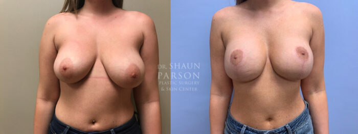 Breast Lift with Augmentation Patient 20 | Dr. Shaun Parson Plastic Surgery, Scottsdale, AZ