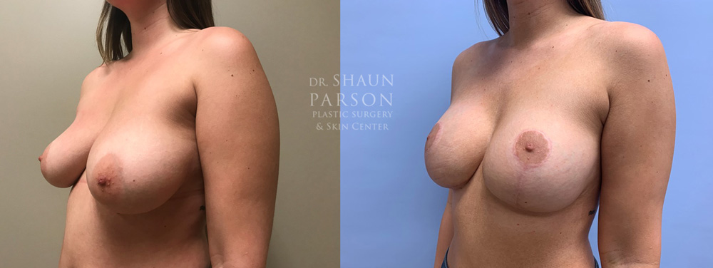 Breast Lift with Augmentation Patient 20 | Scottsdale Plastic Surgeon, Dr. Shaun Parson