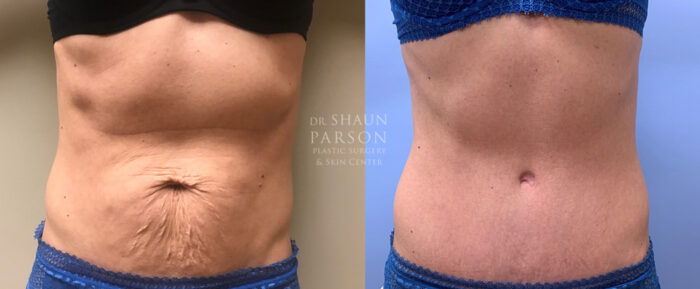 Tummy Tuck Patient 30 | Dr. Shaun Parson | Scottsdale, AZ