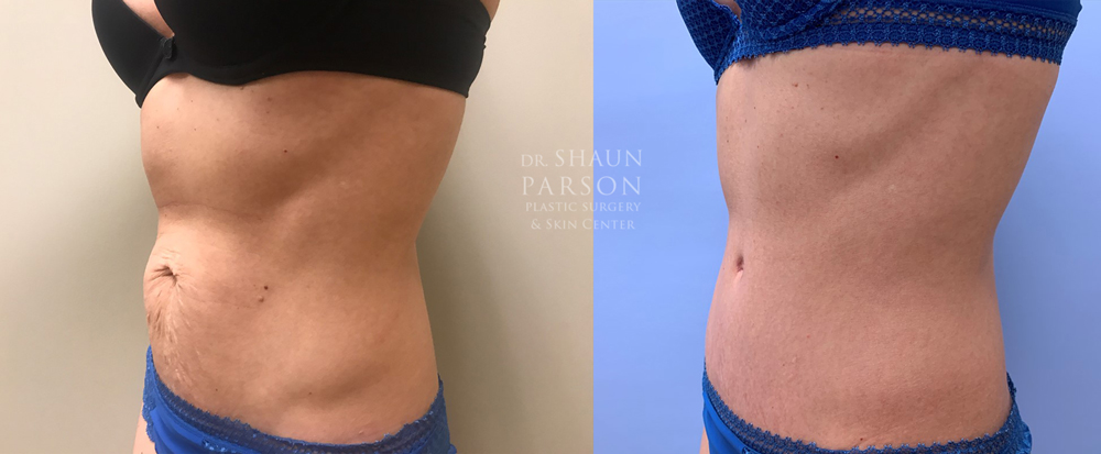 Tummy Tuck Patient 30 | Dr. Shaun Parson | Scottsdale, AZ