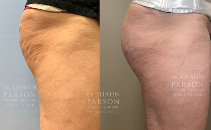 Sculptra Butt Lift | Dr. Shaun Parson, Scottsdale