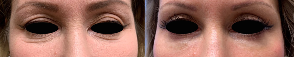 Eyelid Surgery Patient 29 | Scottsdale Plastic Surgeon