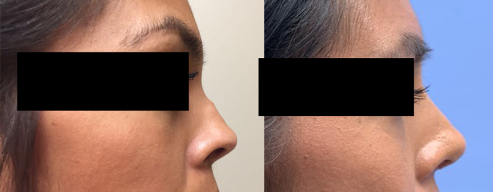 Rhinoplasty Patient 9 | Scottsdale Plastic Surgeon, Dr. Parson