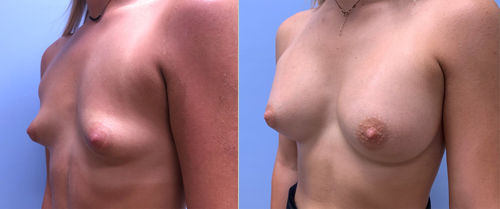 Breast Augmentation Patient 45 | Scottsdale Plastic Surgeon, Dr. Shaun Parson