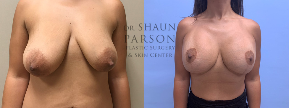 Breast Lift with Augmentation Patient 21 | Scottsdale Plastic Surgeon