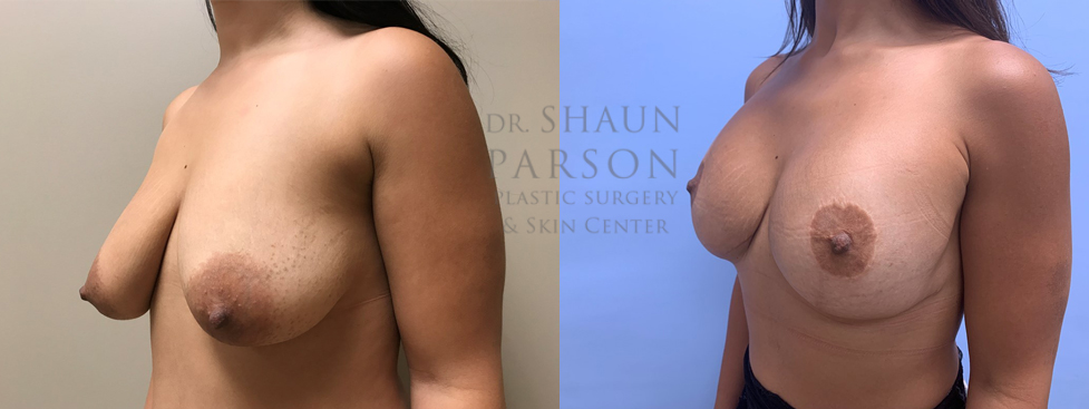 Breast Lift with Augmentation Patient 21 | Scottsdale Plastic Surgeon