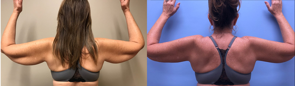 Arm Lift Patient 3 | Dr. Shaun Parson Scottsdale, AZ