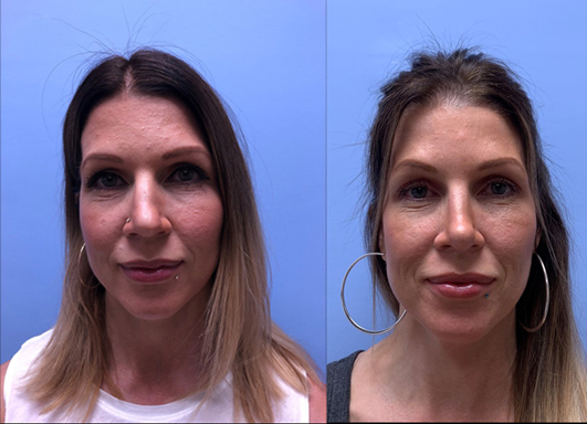 Rhinoplasty Scottsdale Patient 9 | Dr. Shaun Parson Plastic Surgery