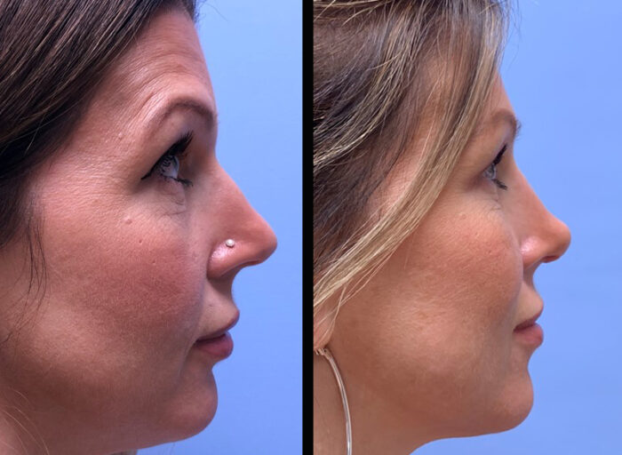 Rhinoplasty Scottsdale | Dr. Shaun Parson Plastic Surgery