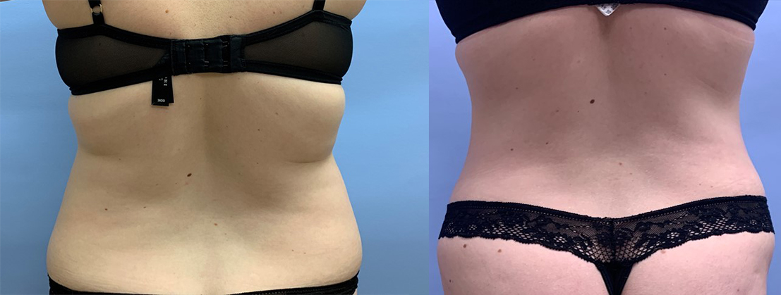 Tummy Tuck Patient 31 | Dr. Shaun Parson, Scottsdale