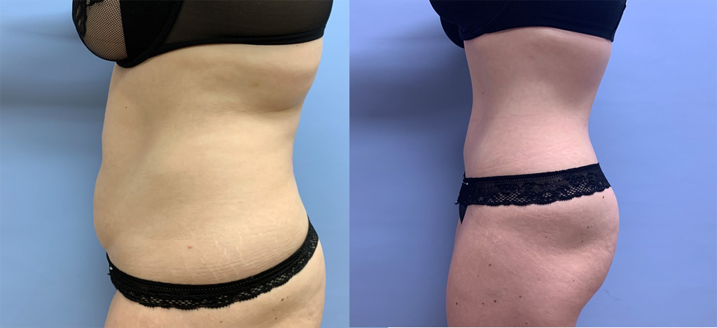 Tummy Tuck Patient 31 | Dr. Shaun Parson, Scottsdale