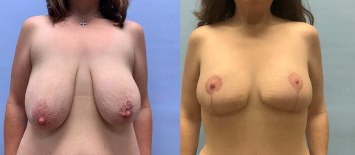 Breast Lift Patient 19 | Scottsdale Plastic Surgeon