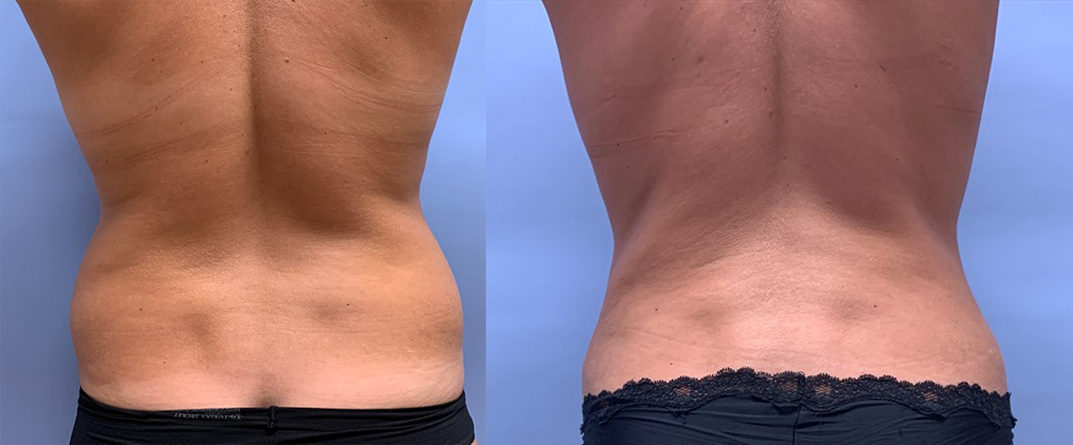 Tummy Tuck Patient 32 | Scottsdale Plastic Surgeon, Dr. Shaun Parson