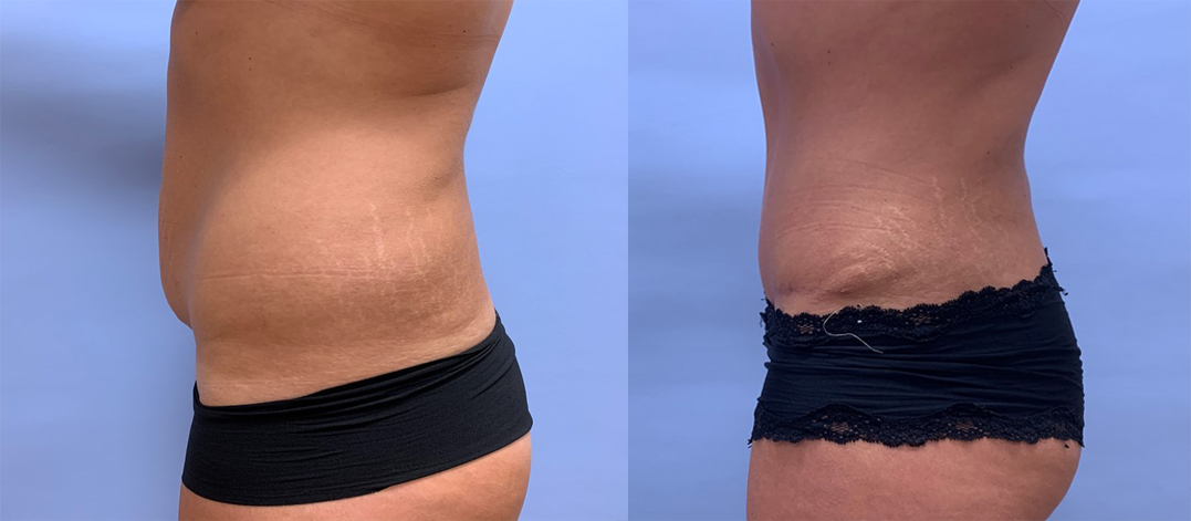 Tummy Tuck Patient 32 | Scottsdale Plastic Surgeon, Dr. Shaun Parson