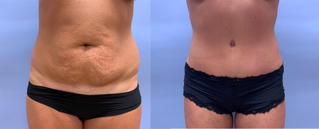 Tummy Tuck Patient 32 | Scottsdale Plastic Surgeon, Dr. Shaun Parson