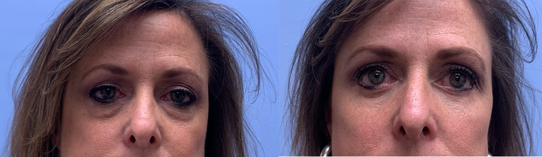 Eyelid Surgery Patient 31 | Scottsdale Plastic Surgeon, Dr. Parson