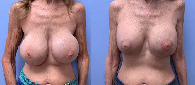 Breast Revision Patient 16 | Dr. Shaun Parson Plastic Surgery