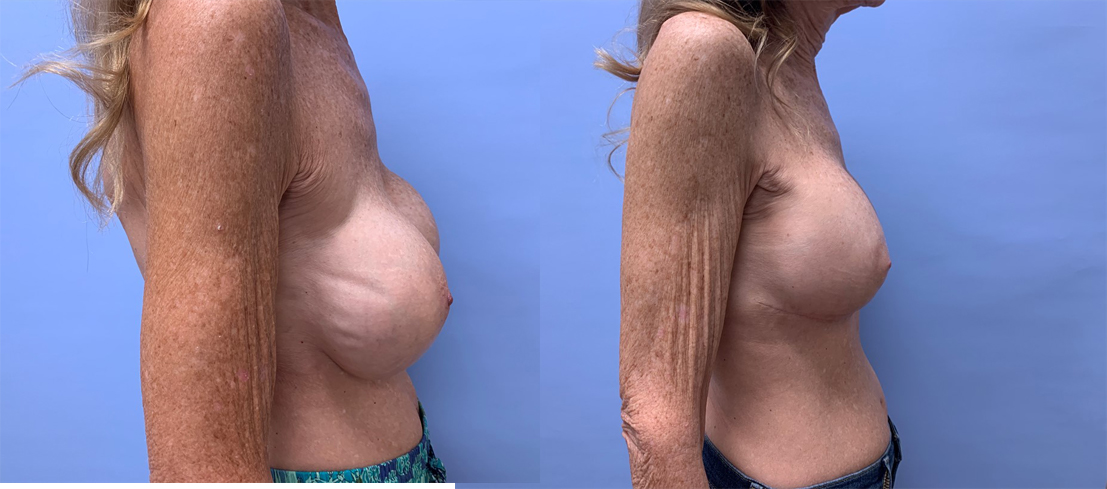 Breast Revision Patient 16 | Dr. Shaun Parson Plastic Surgery