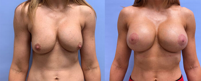 Breast Revision Patient 17 | Scottsdale Plastic Surgeon, AZ