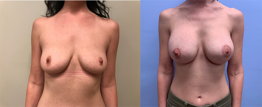 Peri-Areolar Lift with Augmentation | Dr. Shaun Parson Plastic Surgery