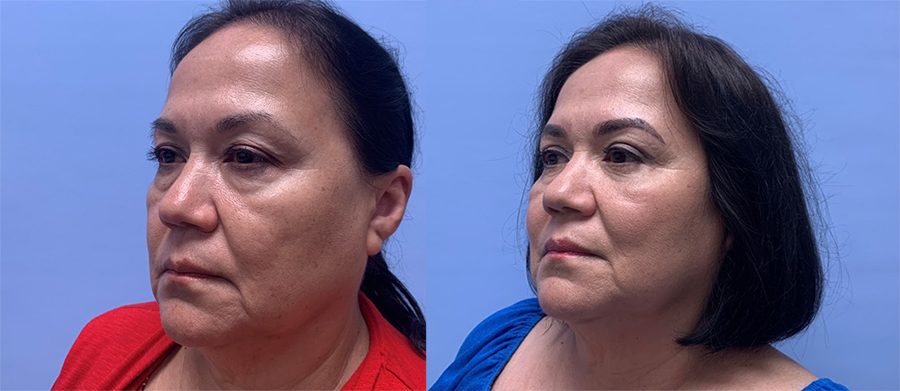 Eyelid Surgery Patient 32 | Scottsdale Plastic Surgeon Dr. Parson