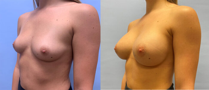 Breast Augmentation Patient 46 | Dr. Shaun Parson Scottsdale, AZ