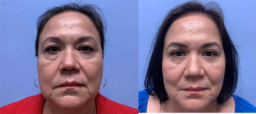 Eyelid Surgery Patient 32 | Scottsdale Plastic Surgeon Dr. Parson