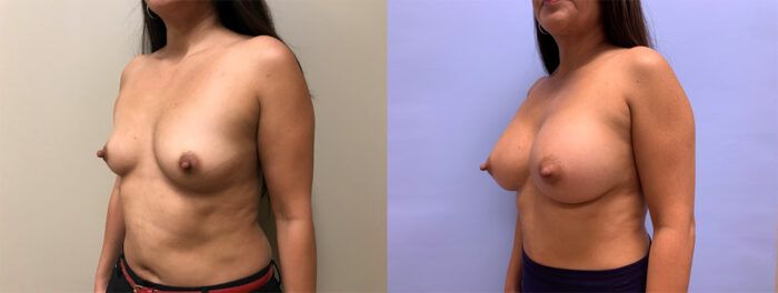 Breast Augmentation Patient 47 | Dr. Shaun Parson Scottsdale, AZ