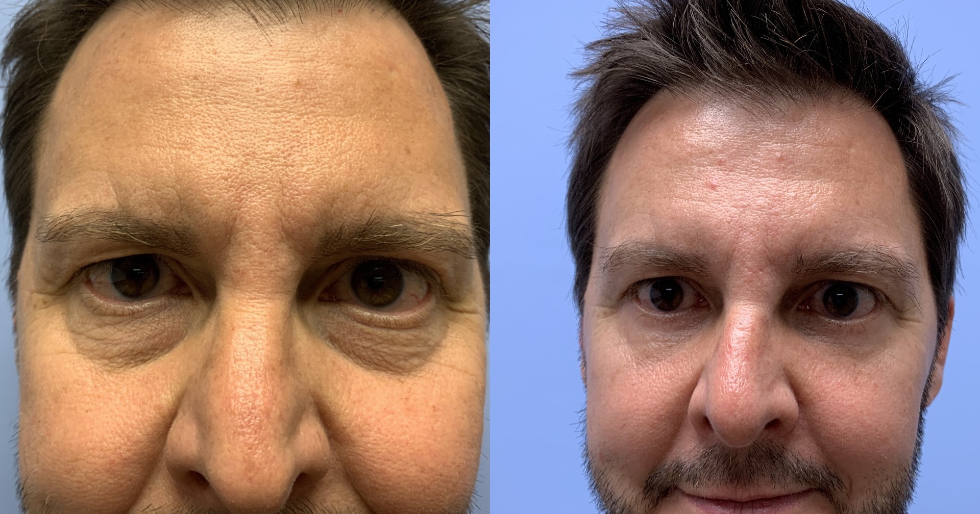 Eyelid Surgery Patient 33 | Dr. Shaun Parson Plastic Surgery, Scottsdale