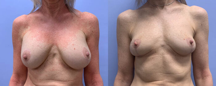 Breast Explant Patient 11 | Scottsdale Plastic Surgeon, Dr. Shaun Parson