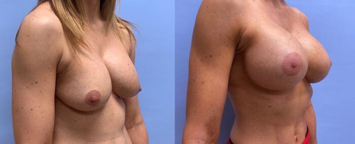 Breast Lift with Peri-Areolar Augmentation Patient 35