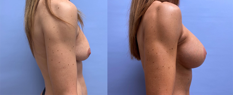 Breast Lift with Peri-Areolar Augmentation Patient 35