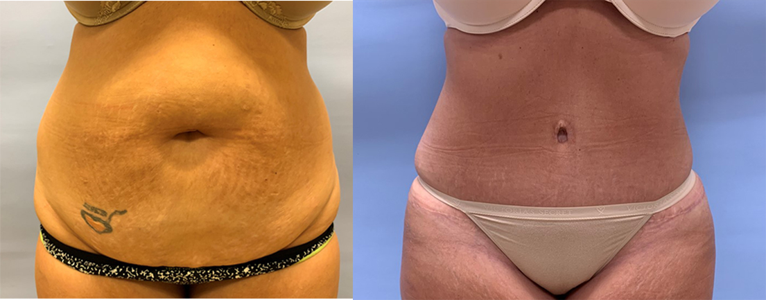 Tummy Tuck Patient 34 | Scottsdale Plastic Surgeon, Dr. Shaun Parson