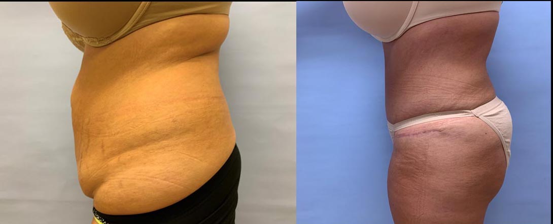 Tummy Tuck Patient 34 | Scottsdale Plastic Surgeon, Dr. Shaun Parson