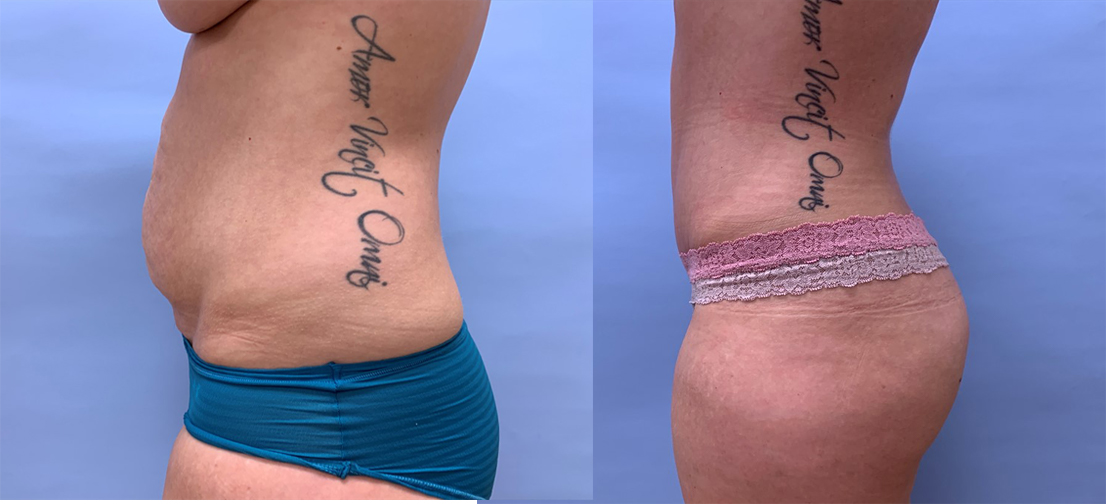 Tummy Tuck Patient 33 | Scottsdale Plastic Surgeon, Dr. Shaun Parson