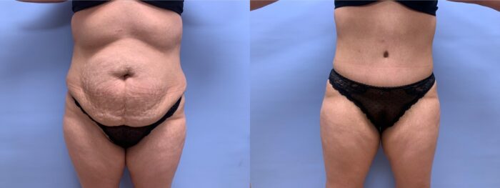 Tummy Tuck Patient 35 | Scottsdale Plastic Surgeon, Dr. Shaun Parson