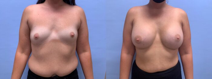 Breast Augmentation Patient 50 | Dr. Shaun Parson Scottsdale, AZ