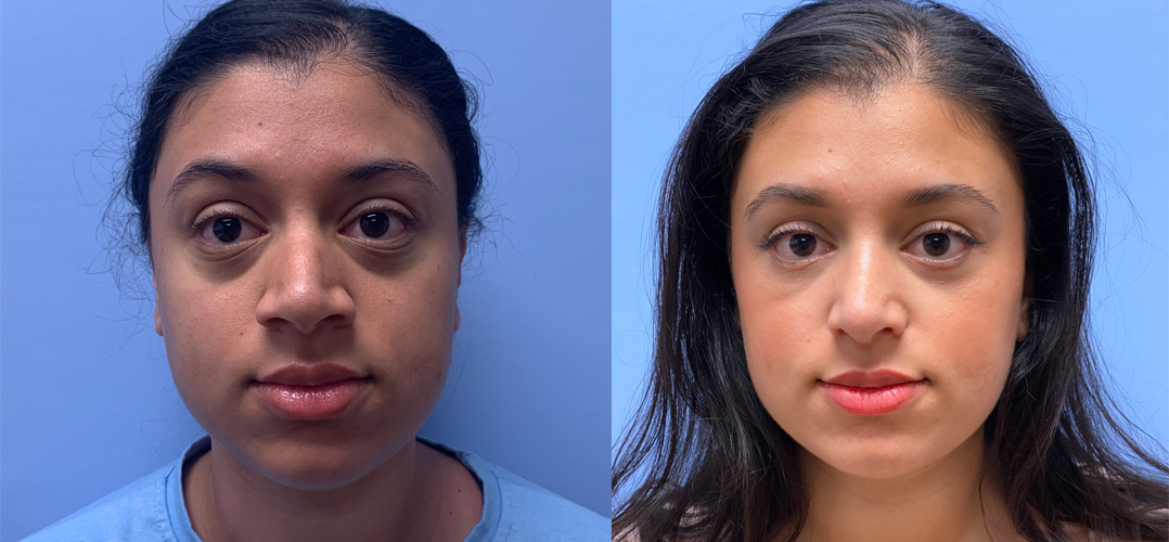 Lower Blepharoplasty Patient 35 | Scottsdale, AZ