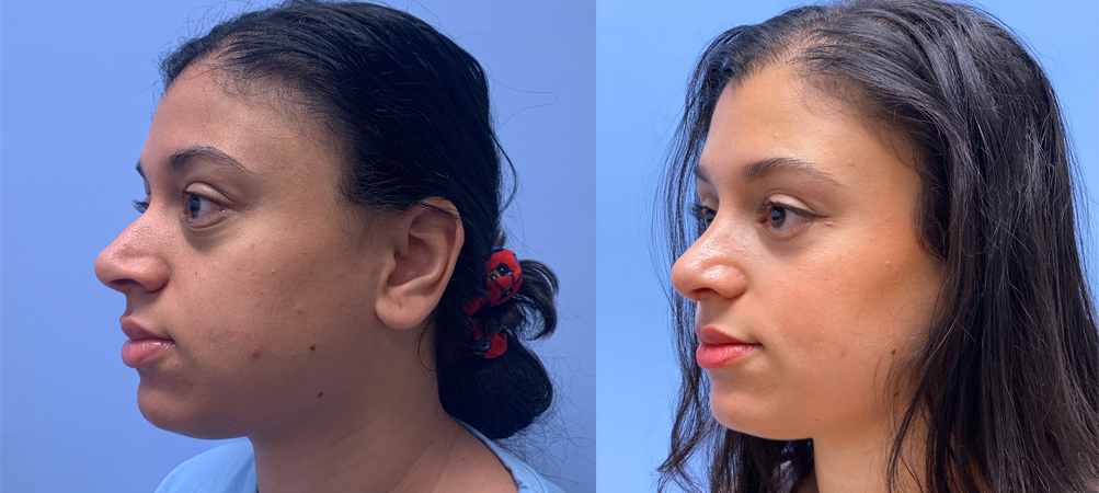 Lower Blepharoplasty Patient 35 | Scottsdale, AZ